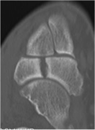 Navicular Fracture CT